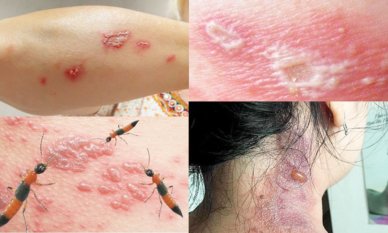 Cửa Chống Kiến Ba Khoang vết bỏng do nọc độc kiến ba khoang gây ra